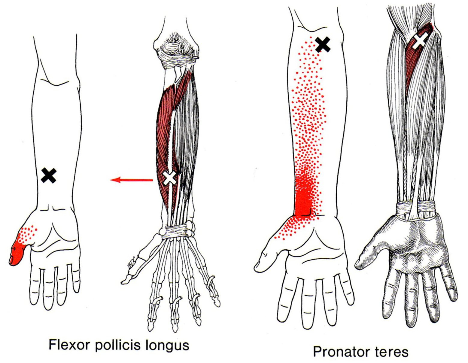 Flexor Pollicis Longus The Trigger Point Referred Pain Guide